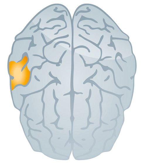 bluish_grey_brain_with_orange_area_highlighted_to_indicate_tinnitus_from_test_result_conducted_by_pure_sound_hearing_in_strasburg_pa